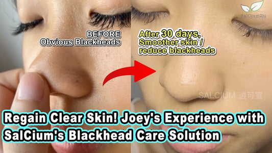 恢復清透肌膚！ Joey 使用 SalCium 黑頭護理解決方案的經驗 Regain Clear Skin! Joey's Experience with SalCium's Blackhead Care Solution