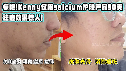 Kenny告别烦人的痘印！如何通过逍可宣SalCium成功实现清爽自信？Kenny says goodbye to annoying acne marks! How to successfully achieve refreshing confidence through SalCium?