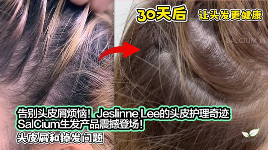 告别头皮屑烦恼！Jeslinne Lee的头皮护理奇迹，SalCium生发产品震撼登场！